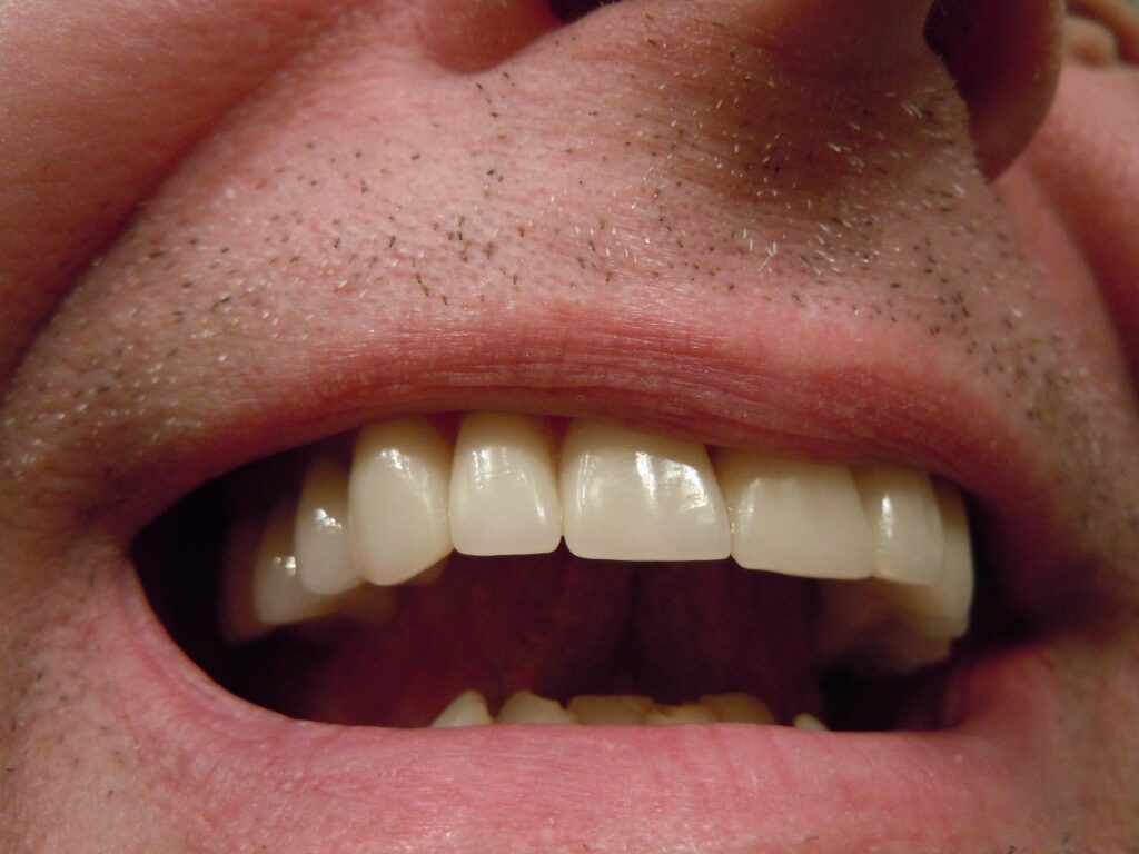 Tartaro-no-dente